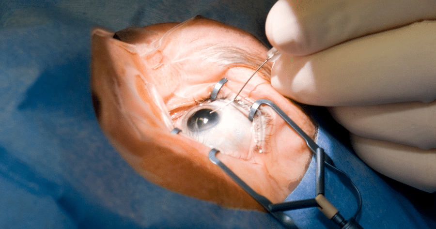 Cataracts Surgeons 